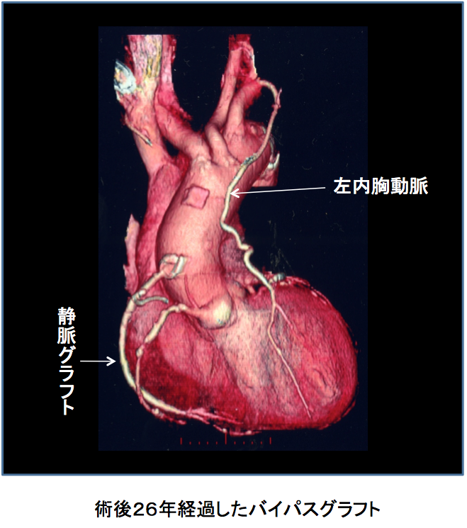 術後26年経過したバイパスグラフト