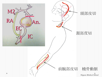 橈骨動脈　グラフトの図 