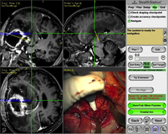 glioma5