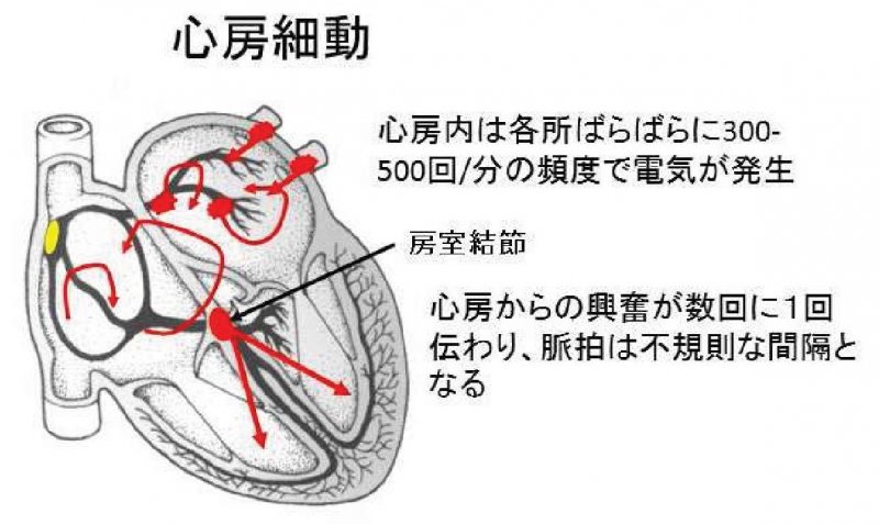 心房細動