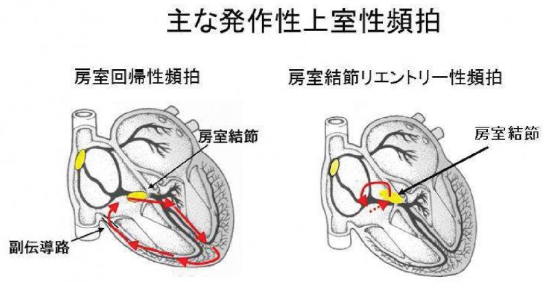 主な発作性上室性頻拍