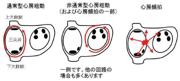 通常型心房粗動・非通常型心房粗動・心房頻拍