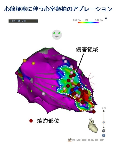 心筋梗塞に伴う心筋頻拍のアブレーション