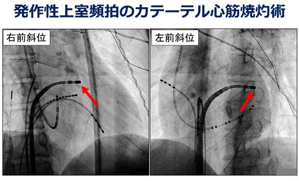 発作性上室性頻拍のカテーテル心筋焼灼術