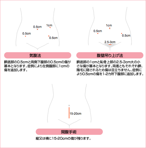 腹腔鏡手術と開腹手術の比較