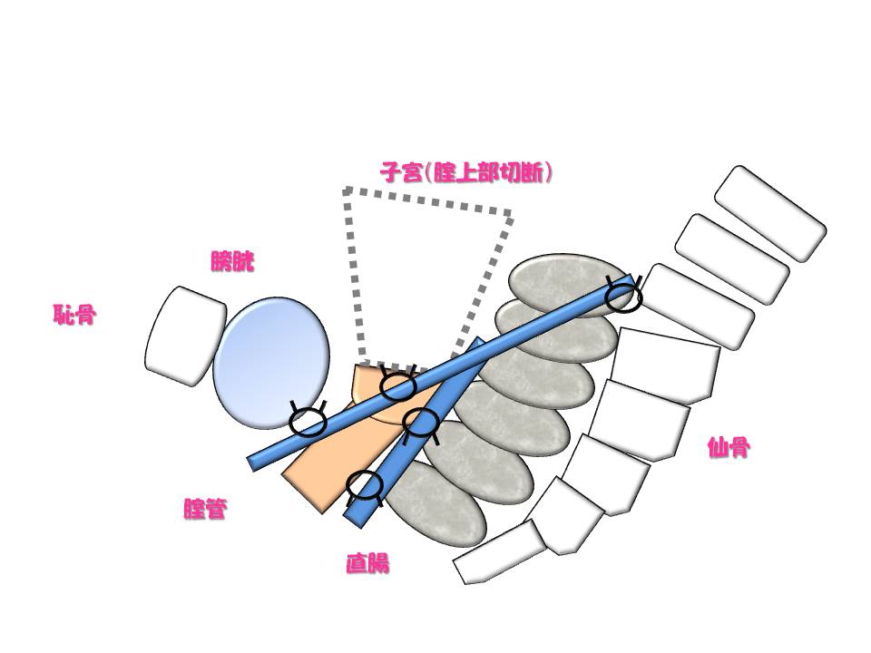 腹腔鏡下仙骨腟固定術