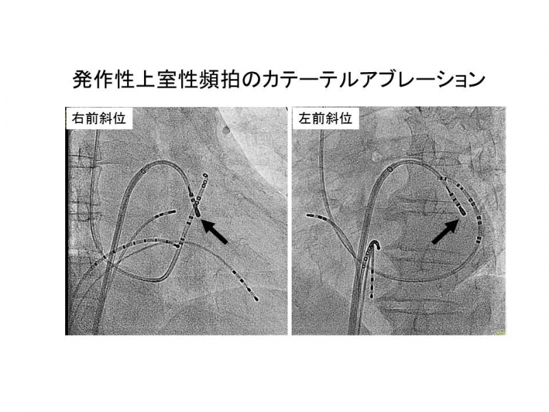 発作性上室性頻拍のカテーテルアブレーション