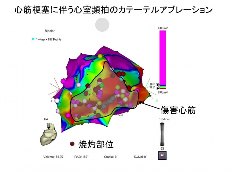 心室頻拍のカテーテルアブレーション