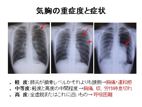 気胸の重症度と症状