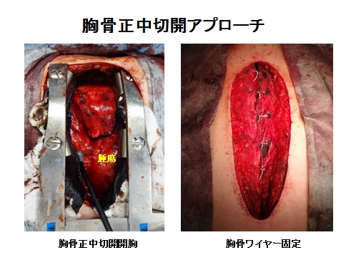 胸骨正中切開アプローチ