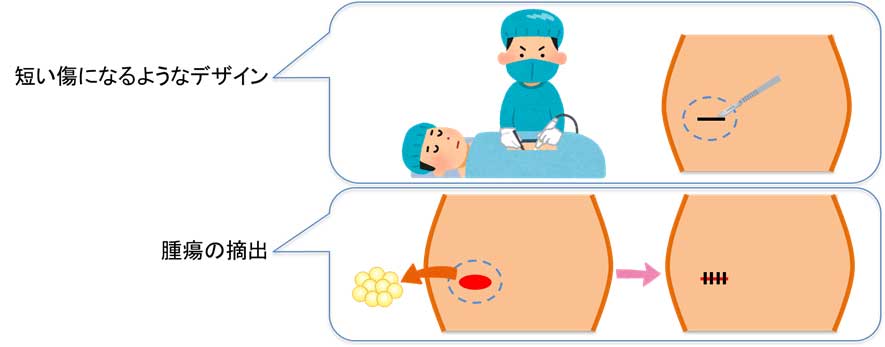 脂肪腫と「良性悪性の判断」と手術（短い傷になるようにデザイン）