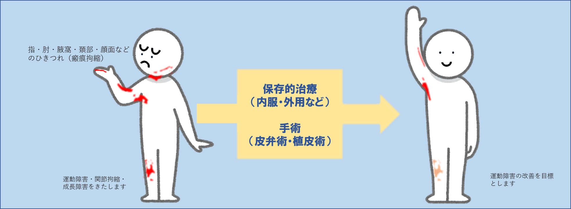 きずあと、傷、やけどあとのひきつれ、瘢痕拘縮