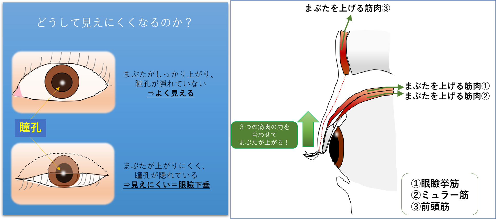 眼瞼下垂とは