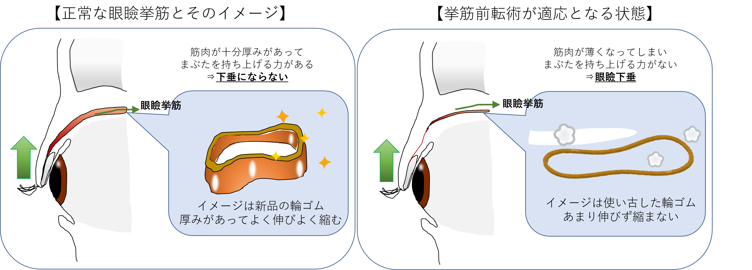 眼瞼下垂の保険診療