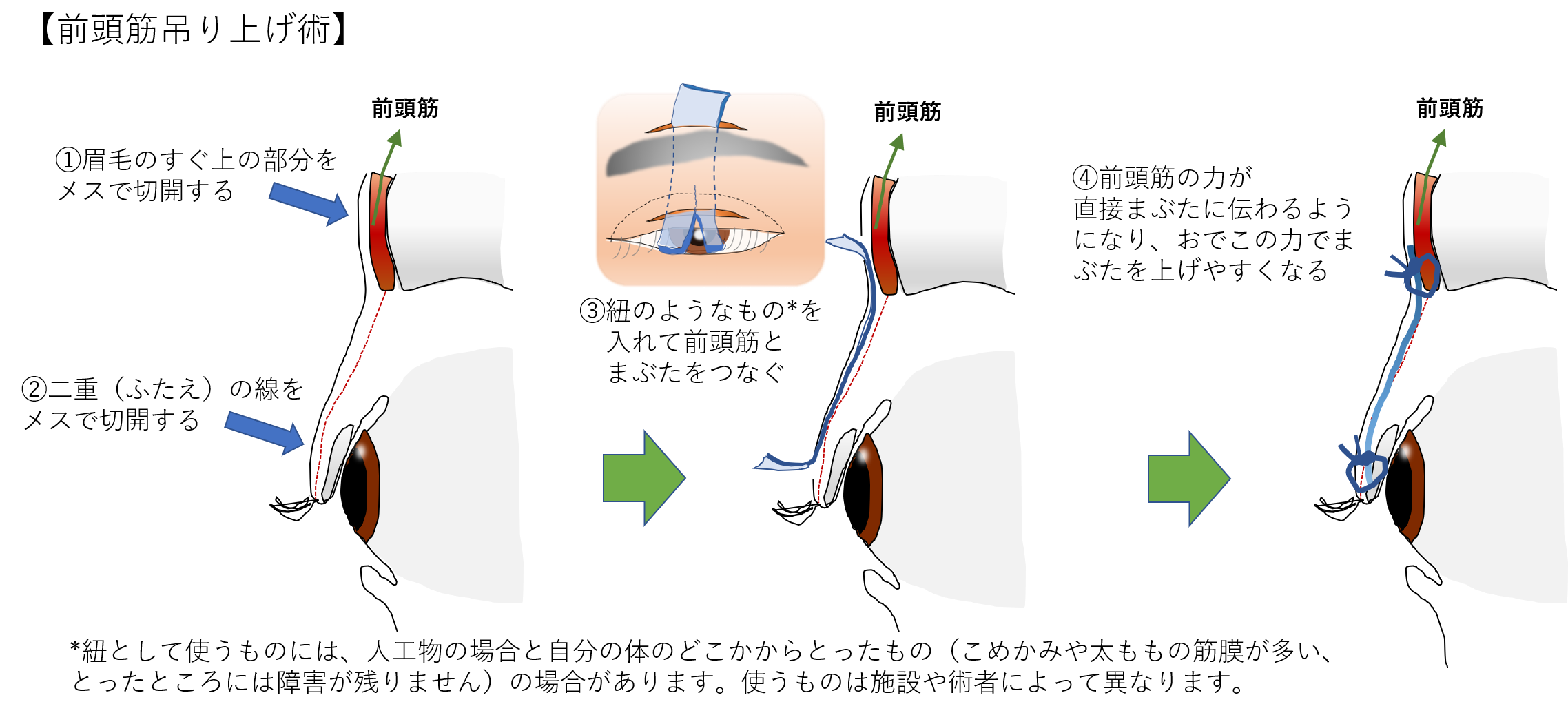 前頭筋つり上げ術