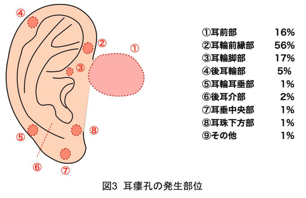 先天性耳瘻孔2