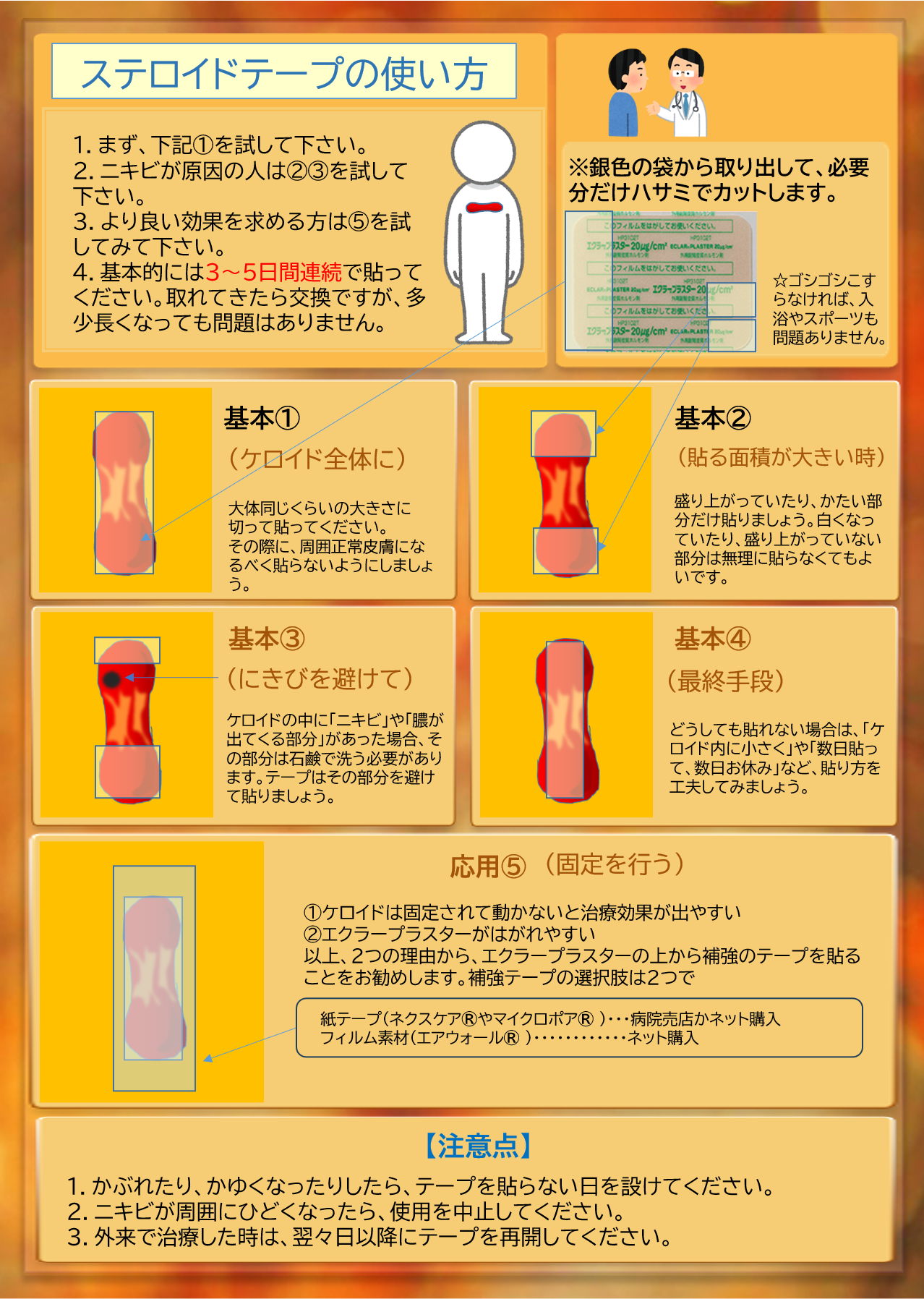 エクラープラスター（ステロイドテープ）の貼り方