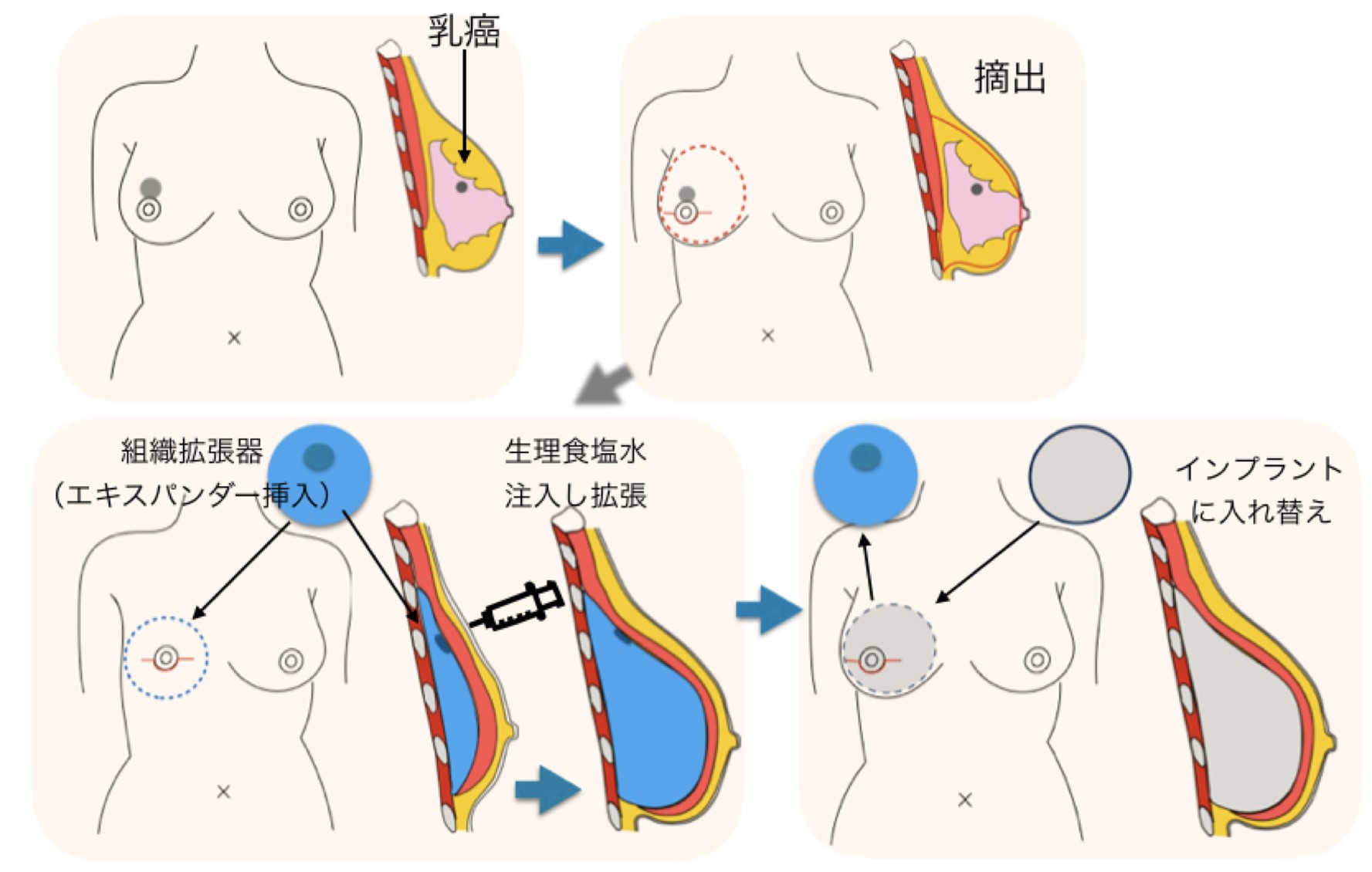 人工物による再建