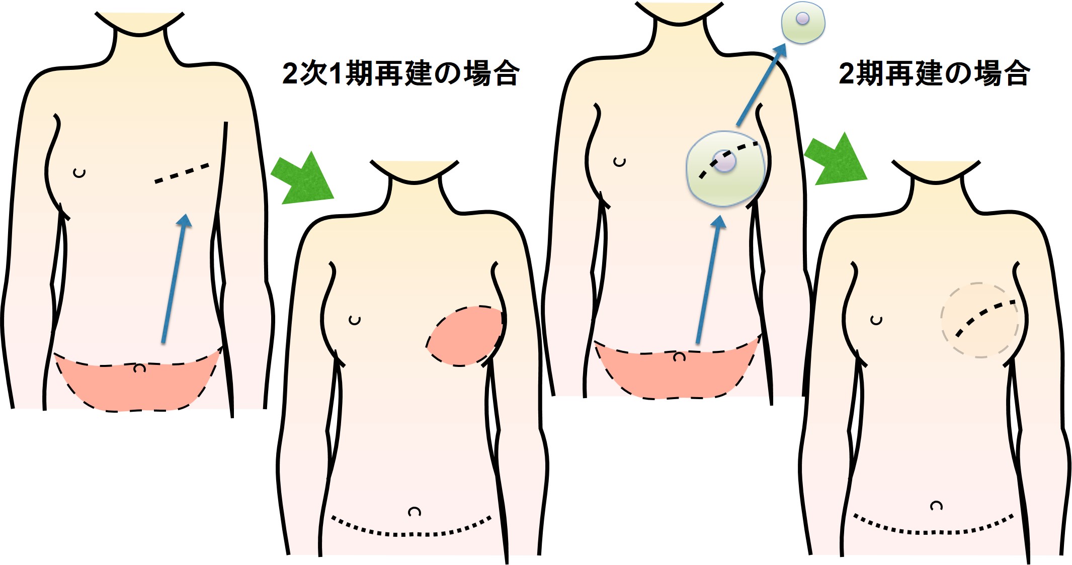 腹直筋皮弁、腹部穿通枝皮弁