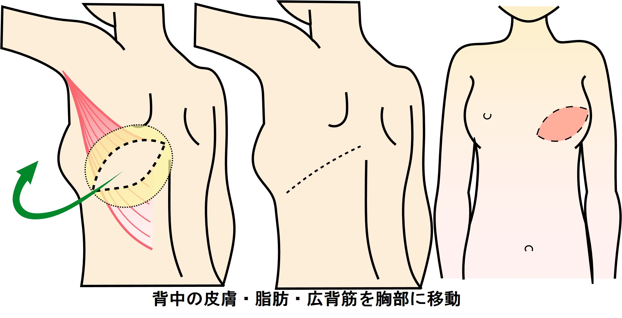 広背筋皮弁