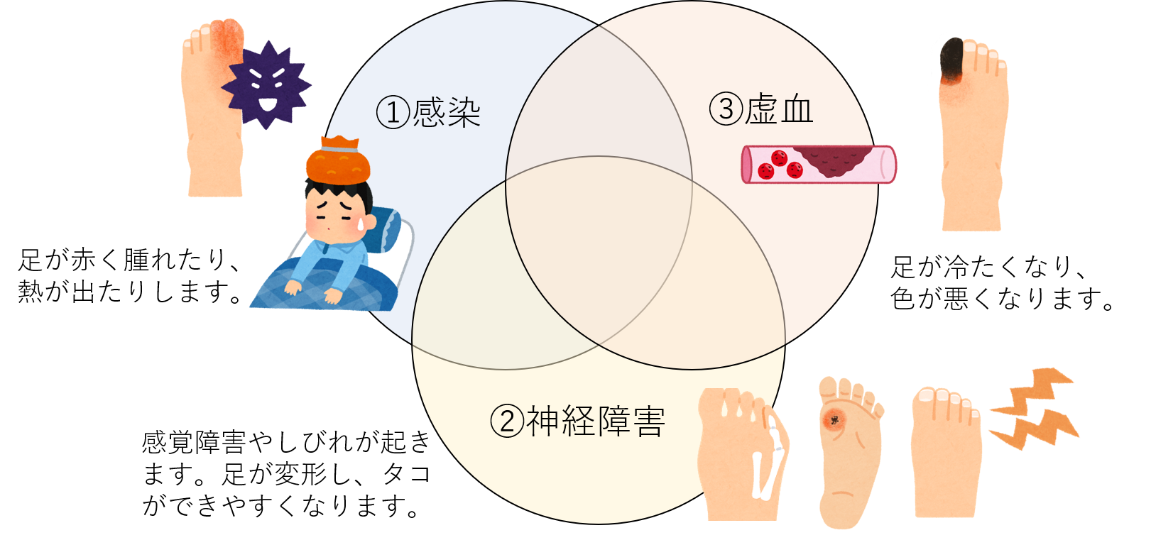 糖尿病性足潰瘍の病態