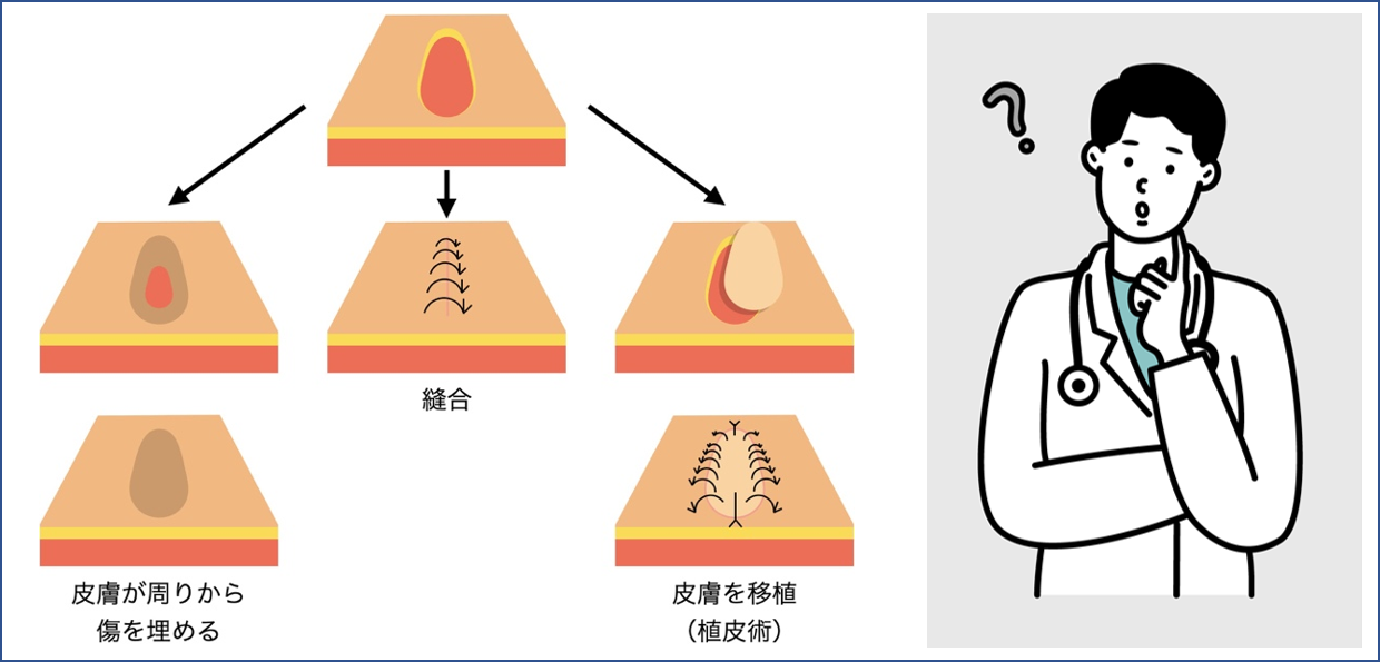 3皮膚潰瘍や糖尿病足病変（足壊疽）につける治療器械（局所陰圧閉鎖療法）