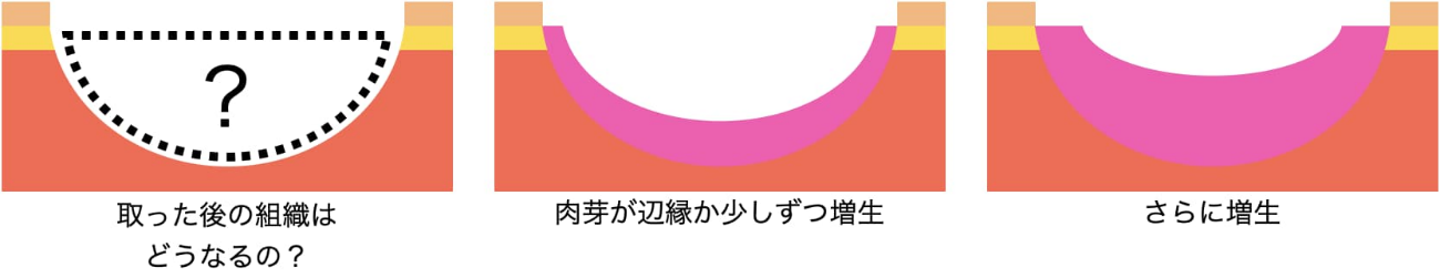 4皮膚潰瘍や糖尿病足病変（足壊疽）につける治療器械（局所陰圧閉鎖療法）