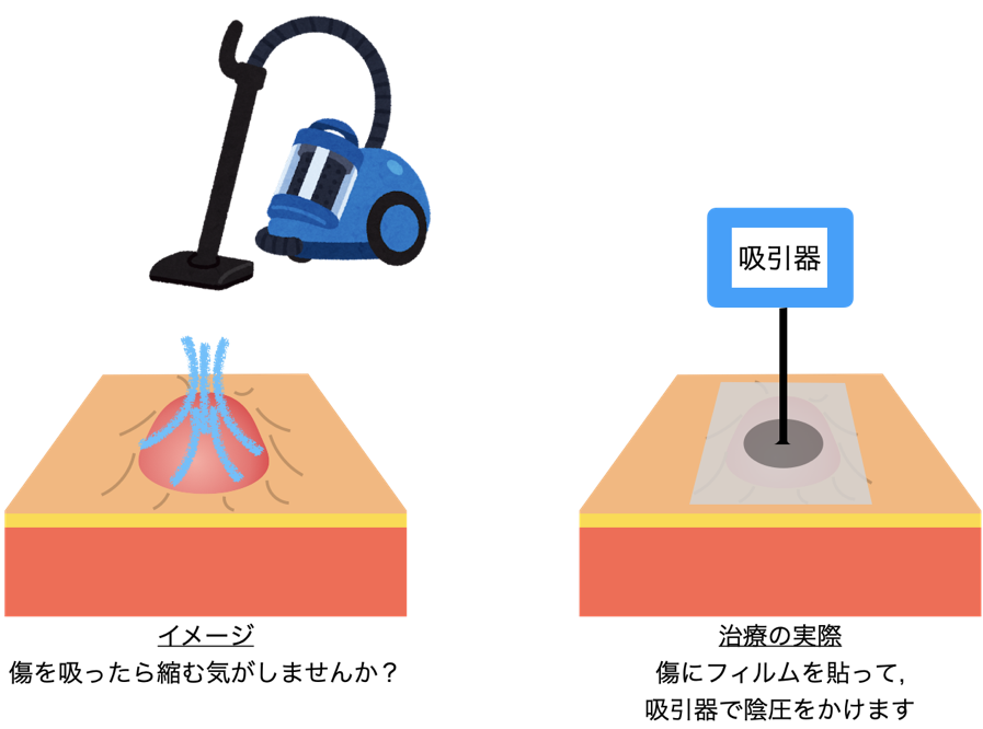 5皮膚潰瘍や糖尿病足病変（足壊疽）につける治療器械（局所陰圧閉鎖療法）