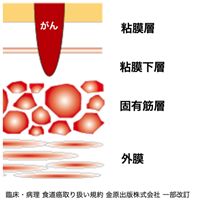 食道がん図1