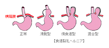 食道裂孔ヘルニア