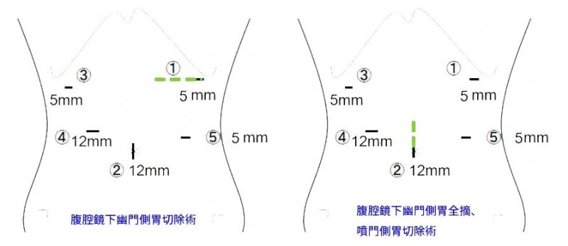 腹腔鏡手術の創部