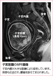 MRI画像