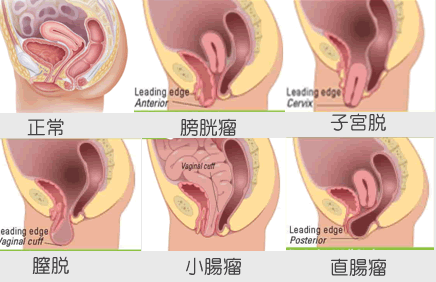 骨盤臓器脱の種類