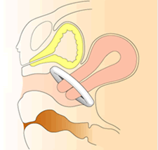 ペッサリーと子宮、膣壁