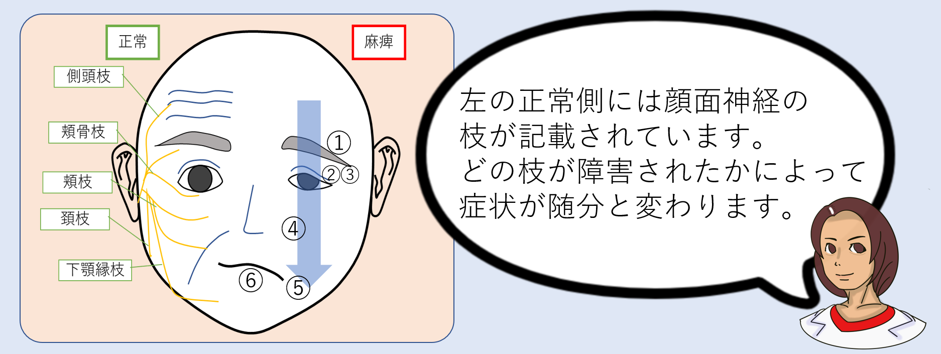 顔面神経麻痺の症状