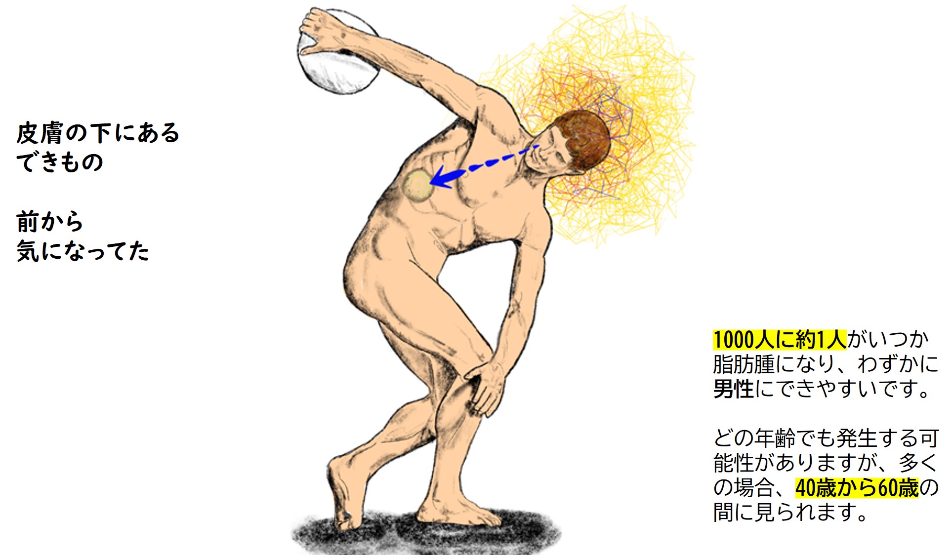 脂肪腫とは 脂肪腫とは