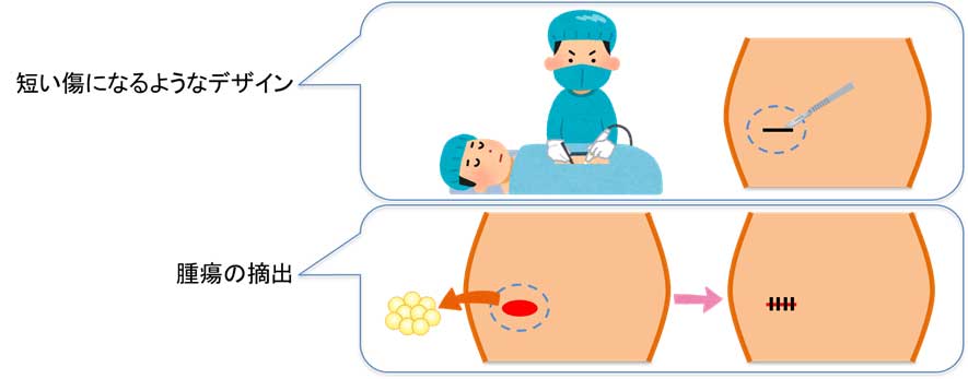 脂肪腫と「良性悪性の判断」と手術(短い傷になるようにデザイン) 脂肪腫と「良性悪性の判断」と手術(短い傷になるようにデザイン)