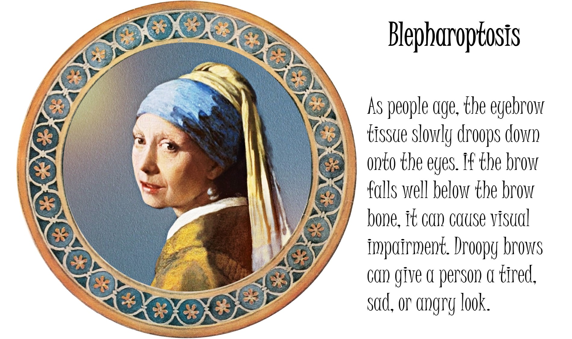 眼瞼下垂(がんけんかすい)東京・神奈川 眼瞼下垂(がんけんかすい)東京・神奈川