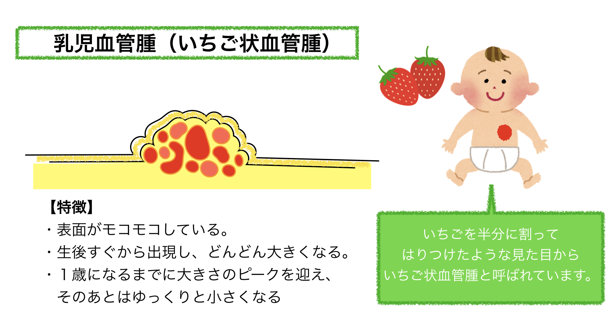 乳児血管腫 乳児血管腫