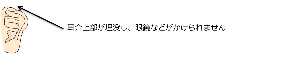 埋没耳 埋没耳