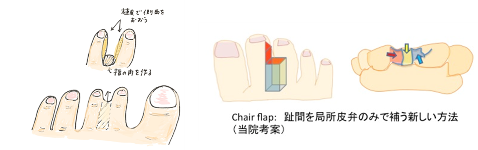 合趾症手術 合趾症手術