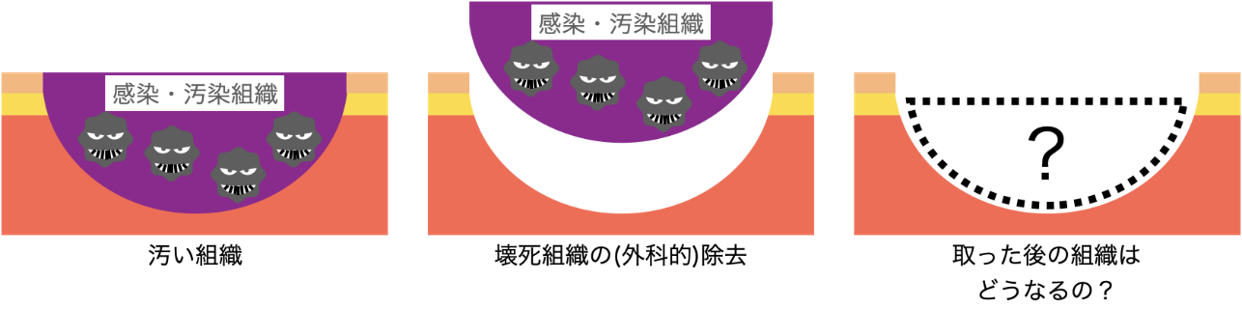 2皮膚潰瘍や糖尿病足病変(足壊疽)につける治療器械(局所陰圧閉鎖療法) 2皮膚潰瘍や糖尿病足病変(足壊疽)につける治療器械(局所陰圧閉鎖療法)