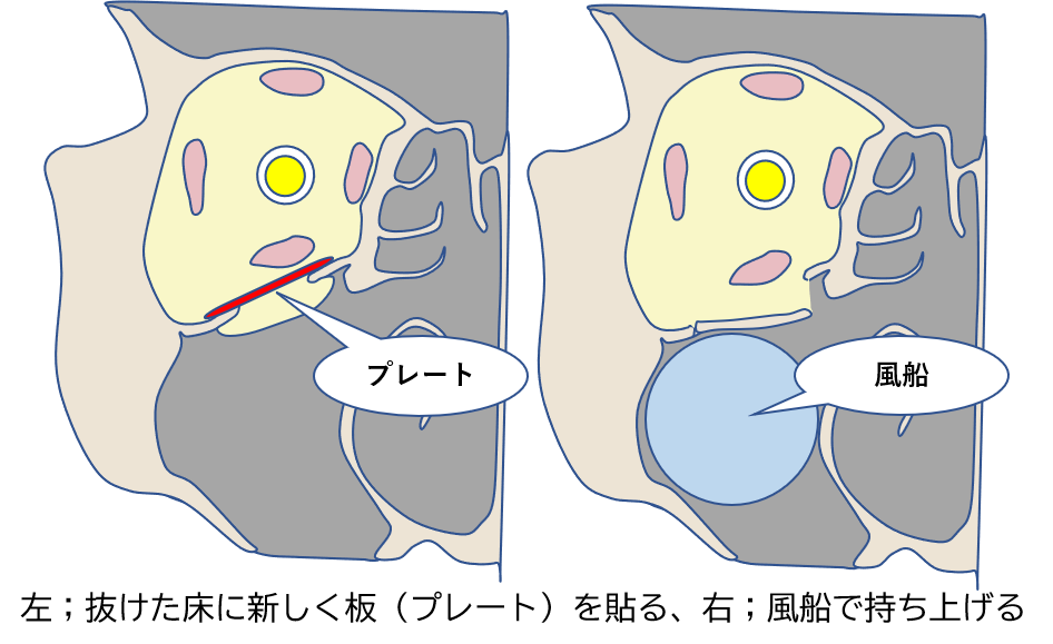 眼窩底骨折2 眼窩底骨折2