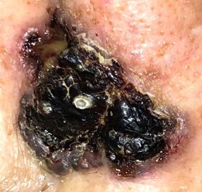 2基底細胞癌 2基底細胞癌