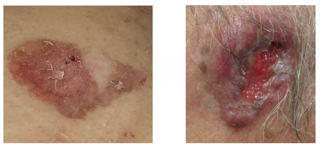 有棘細胞癌201205 有棘細胞癌201205