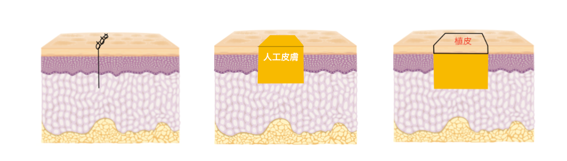 単純縫縮・人工皮膚・植皮 単純縫縮・人工皮膚・植皮