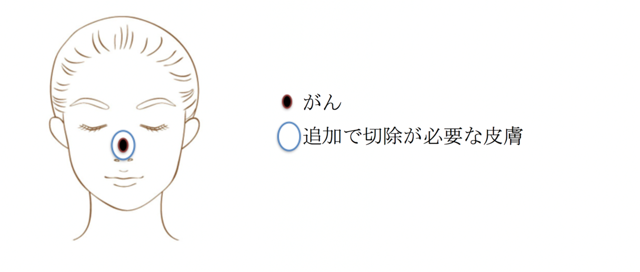 皮膚がんの切除方法と再建(欠損を埋める手術) 皮膚がんの切除方法と再建(欠損を埋める手術)