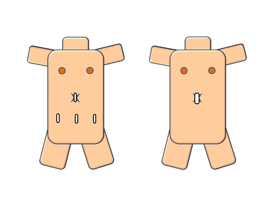 図1 単孔式手術 図1 単孔式手術